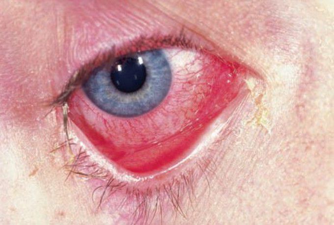 Behcet's syndrome conjunctivitis