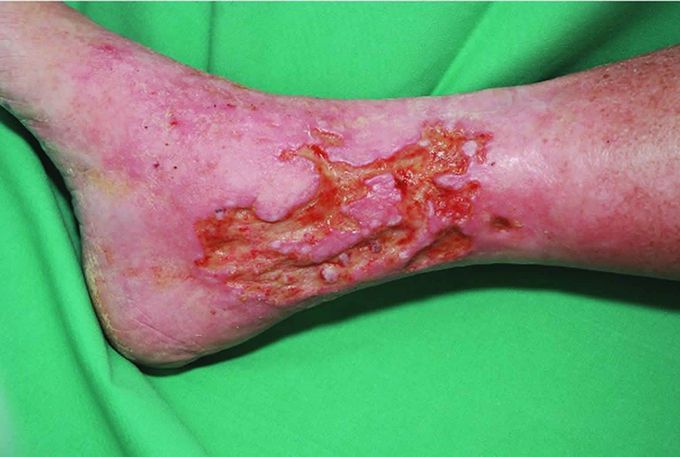 VENOUS SKIN ULCER