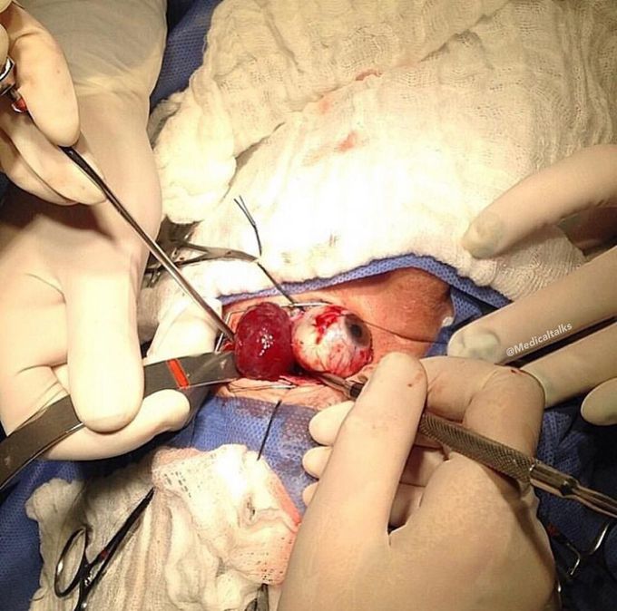 A tumor just behind the orbit!! 