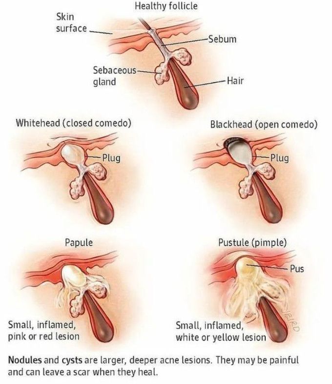 Types of acne lesion