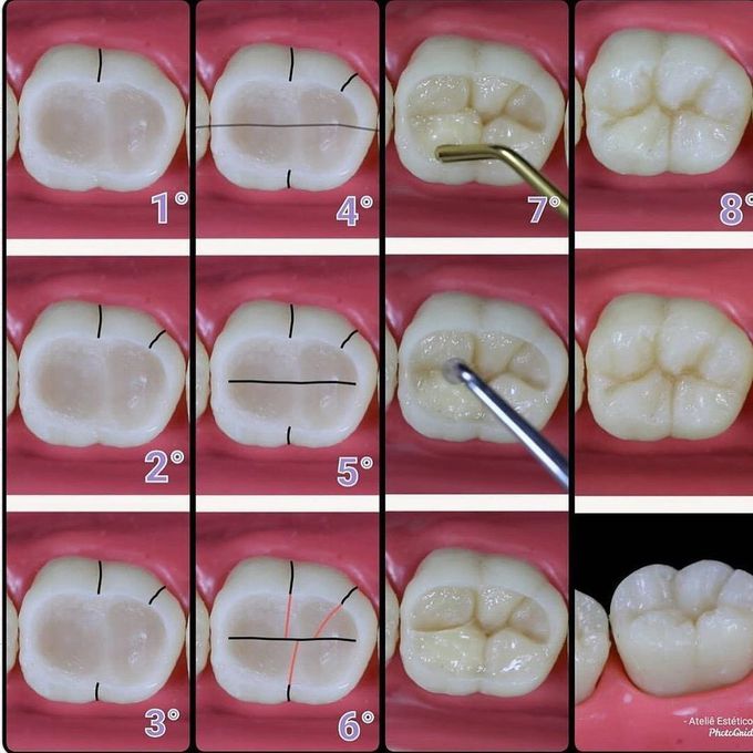 Occlusal morphology of composite restoration