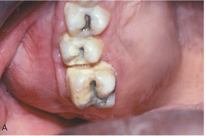 Calcifying Odontogenic Cyst. 