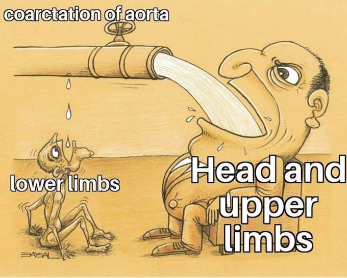 Coarctation of aorta