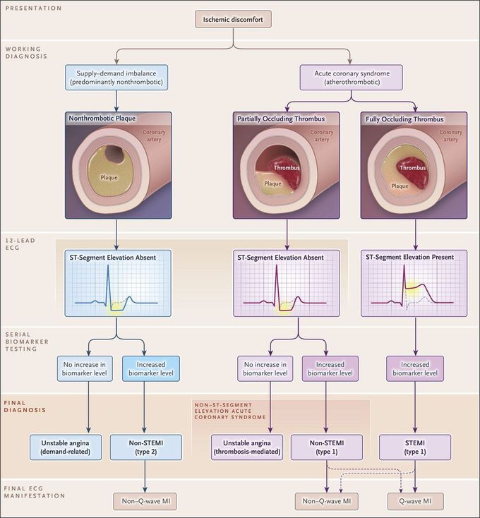 Ischemic discomfort!