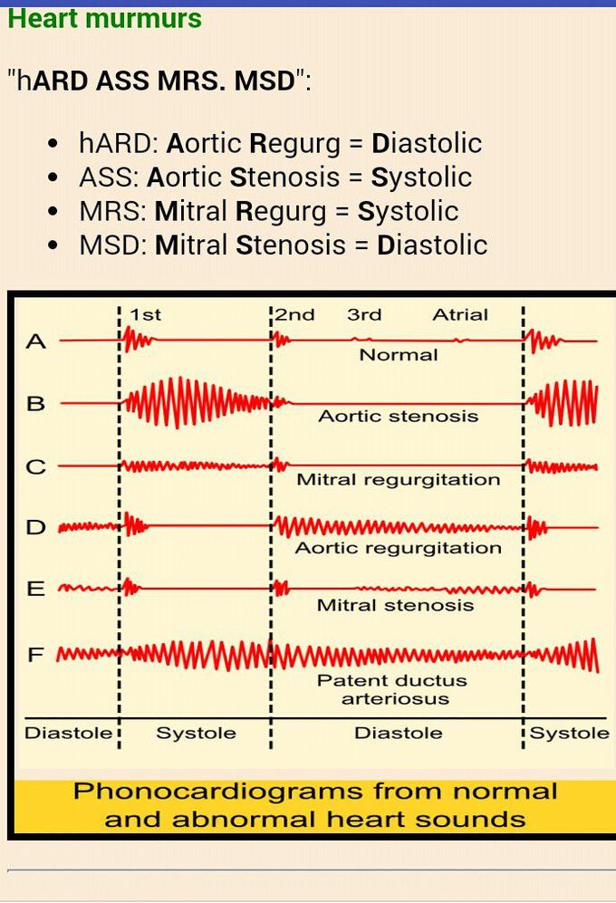 Mnemonics Heart Murmurs Medizzy