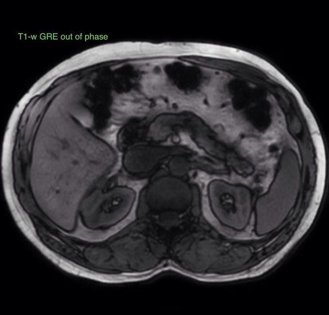 Characteristic chemical shift artifact of the second order (or black boundary or India ink) in T1-w GRE out of phase image