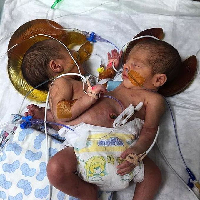 Conjoined twins fused at the abdomen (omphalopagus)