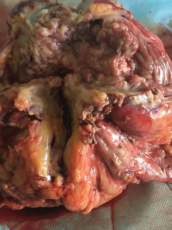 ...for big size tumor