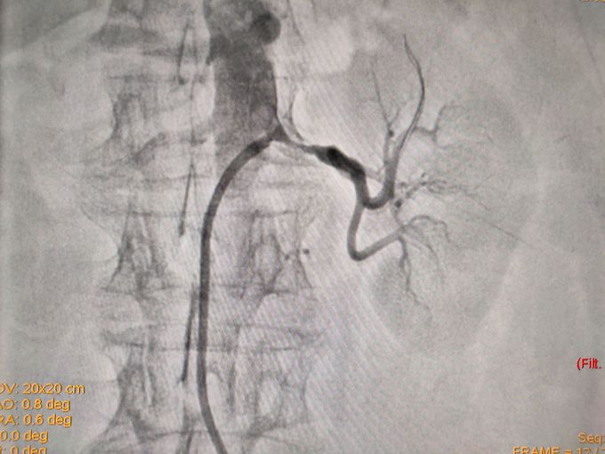 Renal Angioplasty