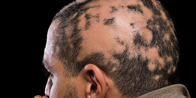 Alopecia Areata