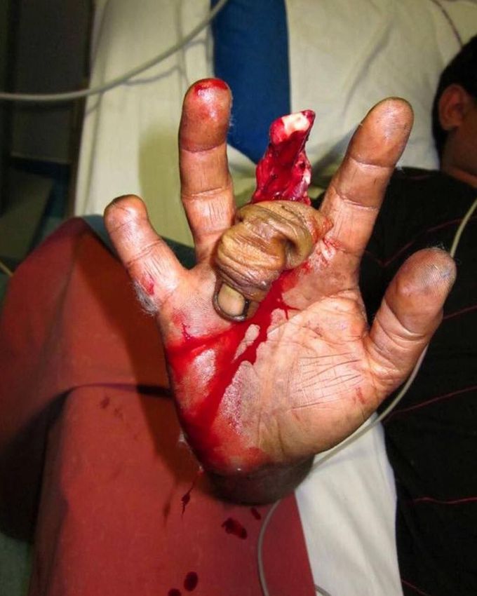 Ring avulsion injury