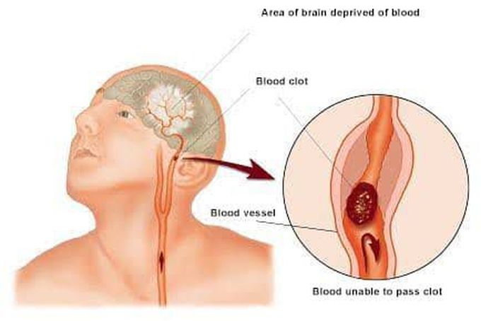 Symptoms of stroke