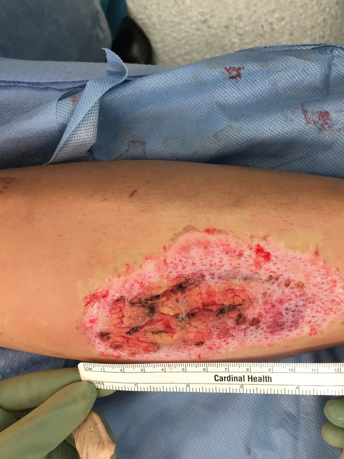 Post debridement of full thickness burn to left lower leg