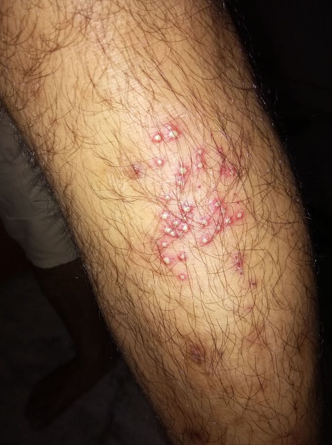 45 year old  men had this Type condition...  What's..  Diagnosis...??