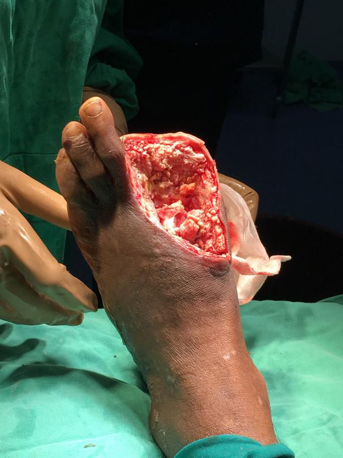 Diabetic foot