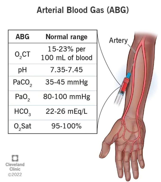 Arterial Blood Gases