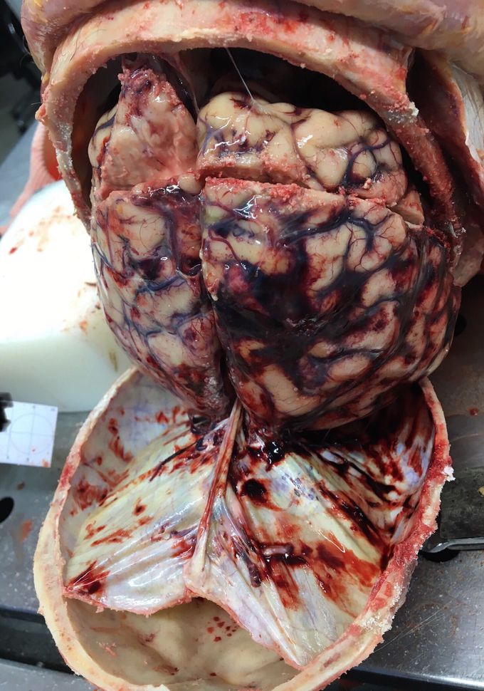Perfect view of Subdural haemorrhagia