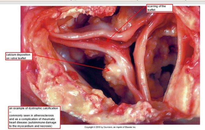 Dystrophic calcification seen on valve leaflets
