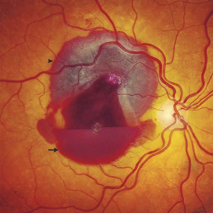 Retinal Hemorrhage from Blunt Ocular Trauma