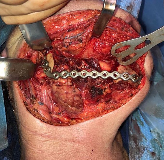 ⚠️❗️AMELOBLASTOMA❗️⚠️