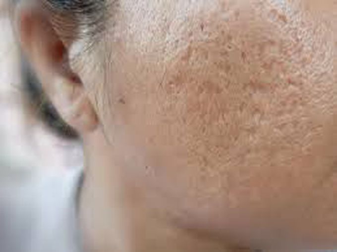 How are acne scars treated?