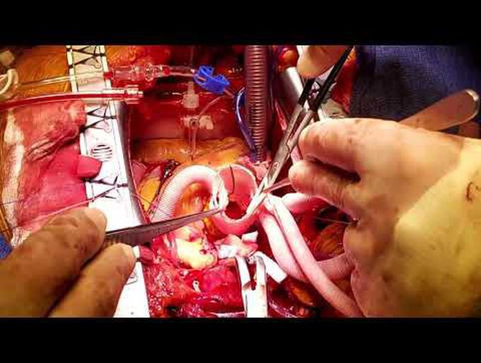 Lupiae Technique, Triple CABG Post TEVAR