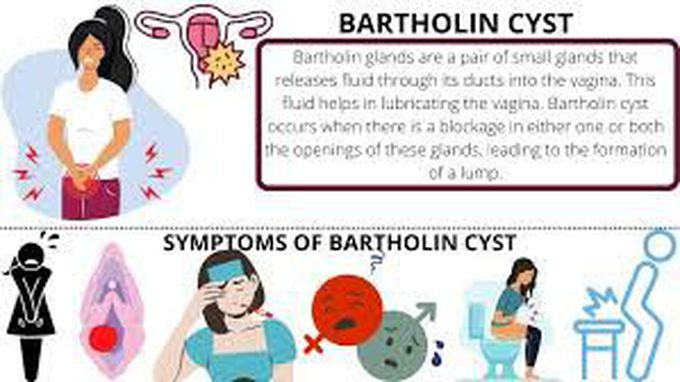 Symptoms of bartholin cyst