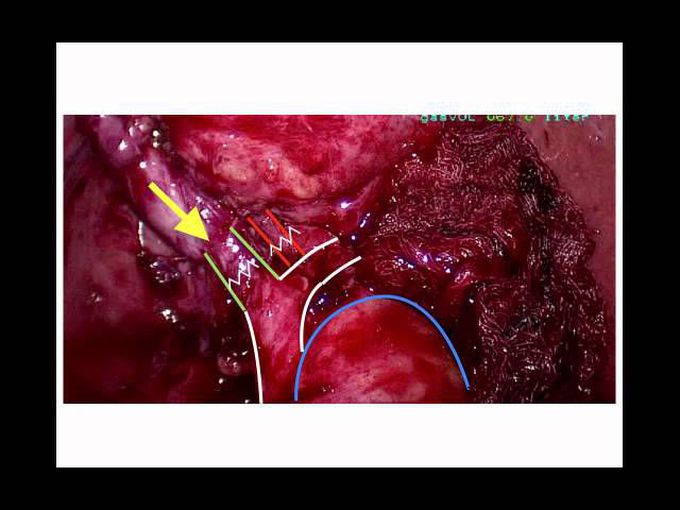 Laparoscopic cholecystectomy explained
