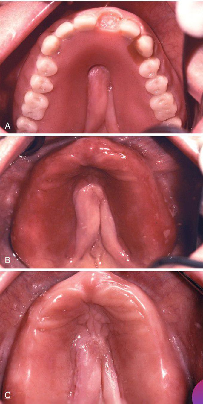 Denture Stomatitis