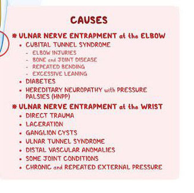 These are the causes of Nerve compression syndrome