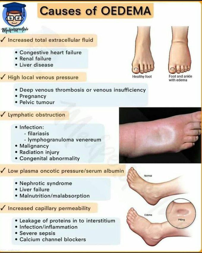Causes of edema