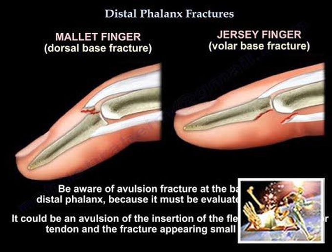 Distal Phalanx Fractures - Everything You Need To Know - Dr. Nabil Ebraheim