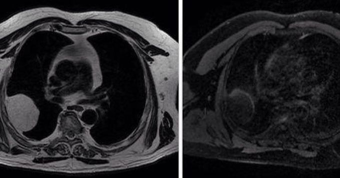 Liposarcoma