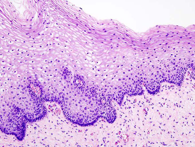 Cervical intraepithelial neoplasia normal