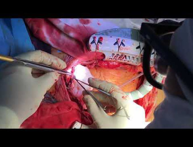 Off-Pump Coronary Artery Bypass I- and T-Graft Technique With "No-Touch" Aorta