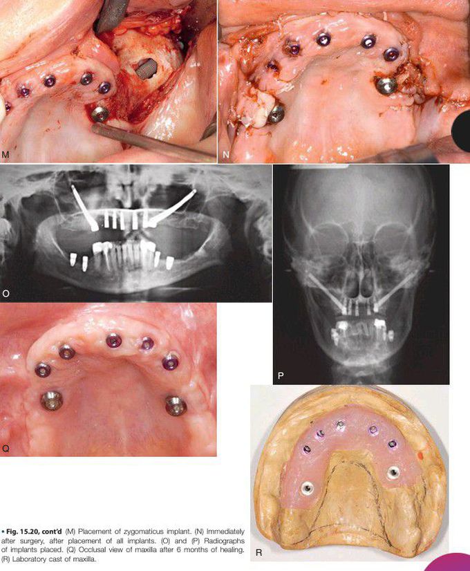 Maxilla rehabilitation