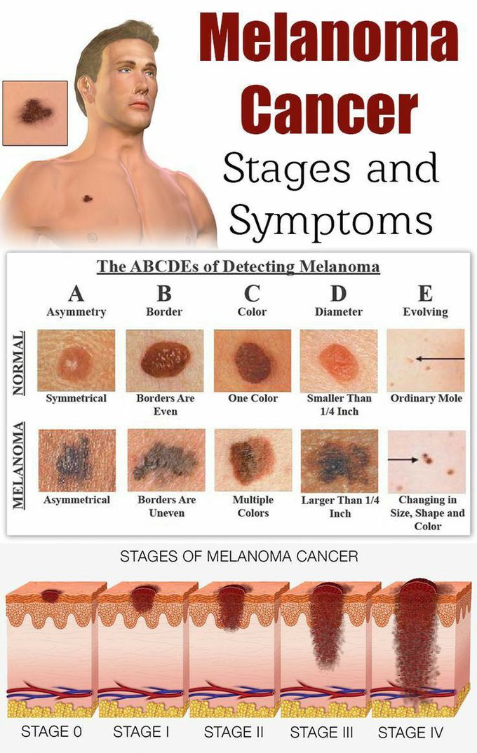 Melanoma
