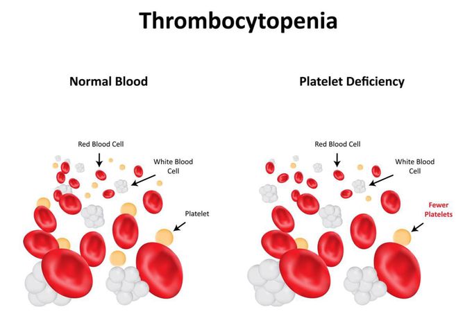 Thrombocytopenia - MEDizzy