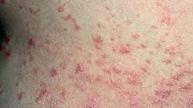 Guttate psoriasis