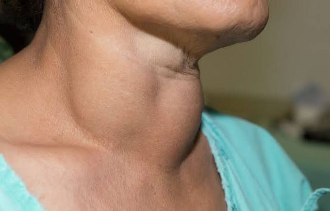 Thyroid nodules