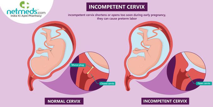 How is incompetent cervix managed or treated