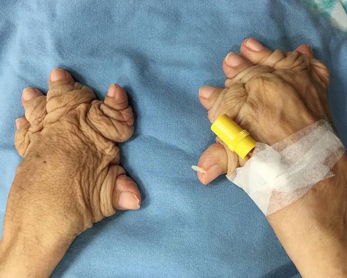 Plummer-Vinson syndrome
