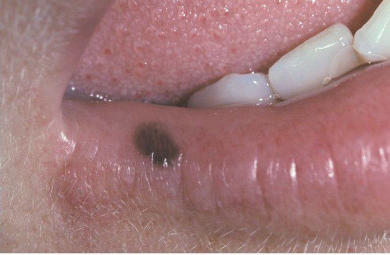 what is melanotic macule Labial melanotic macule. B). Increased numbers of me-lanocytes along