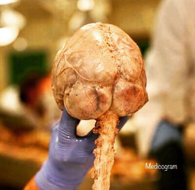 Brain and spinal cord with its coverings (meninges) still intact, and viewed posteriorly. 