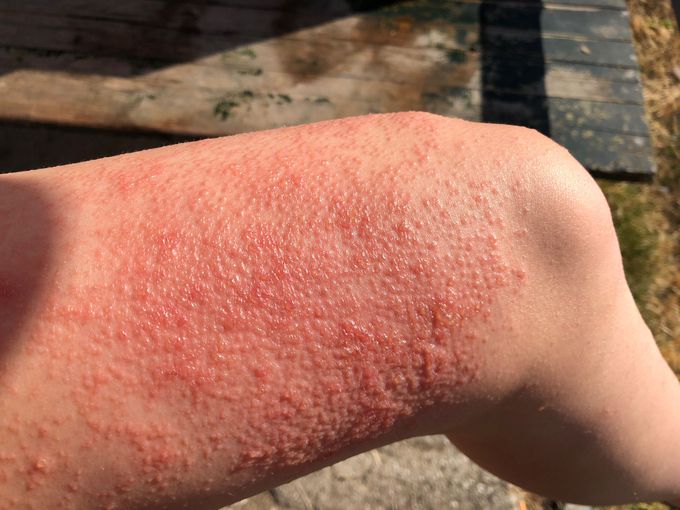 Cutaneous rash