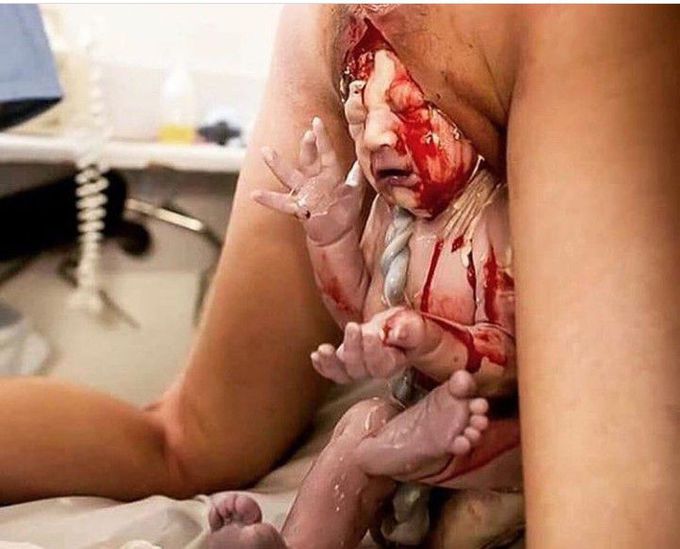 What is the cause of this situation... Baby born with the bottom instead of the head first.