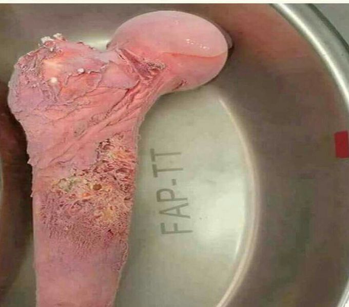 Cancer