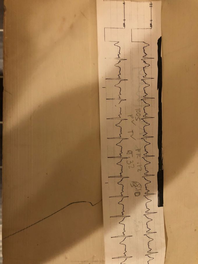 Can you guess the heart rhythm off this telemetry strip? Follow up question: what steps should a nurse take with this heart rhythm (these are called nursing considerations typically) 