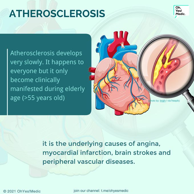 Atherosclerosis