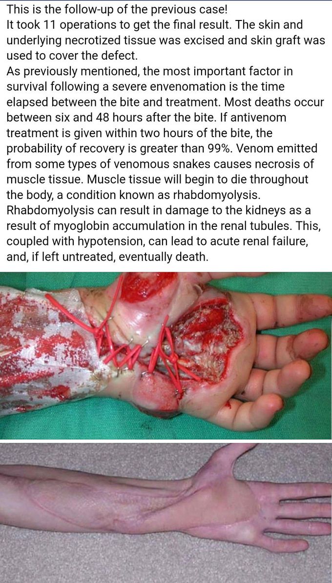 Snake bite.Before and after complete therapy.